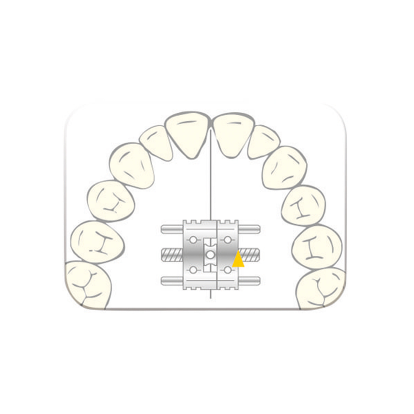 Scheu-dental Vector 200 Expansion Screws